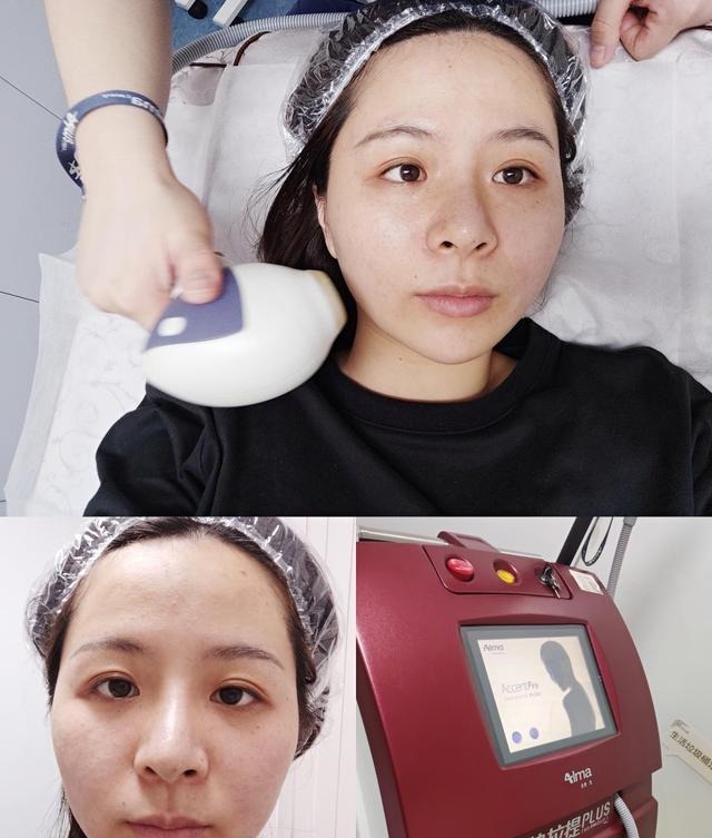 效果 医美抗衰初体验!效果真的很神奇!医美抗衰初体验!效果真的很神奇!