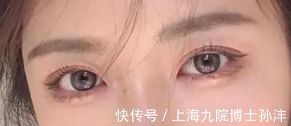 洁净 为什么你的双眼皮手术恢复的比别人慢?