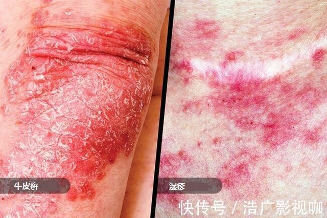 健康|口腔溃疡、胃反酸,11种常见的健康小问题都能用盐解决,天然无害