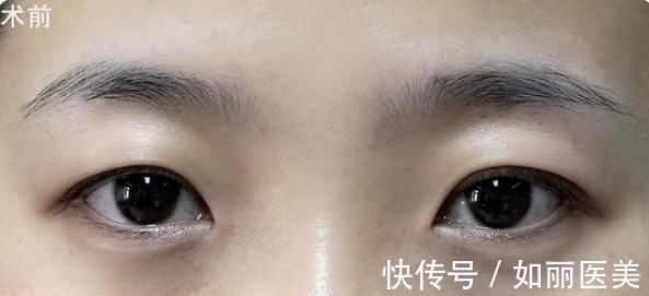 经验 做过全切双眼皮手术的"过来人",分享10条最实用的经验