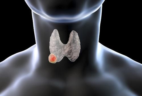 甲状腺激素|33岁女子确诊甲状腺癌，转告家人：这“3物”白送也不要再吃