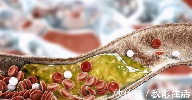 甘油三酯|甘油三酯升高,身体有哪些异常表现?如何预防?医生来讲解