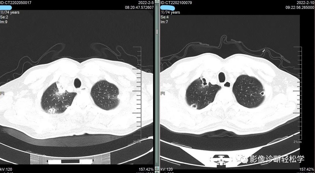 金葡菌|快快乐乐过大年，轻松学习肺部影像 实战篇 续