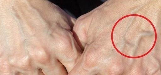 身体|为啥有的人手上的青筋会凸出来青筋越多，对身体有什么影响吗