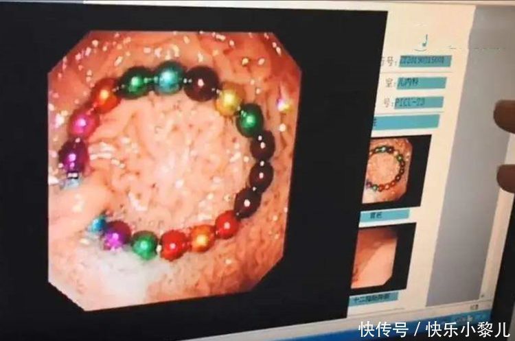 误吞|女孩误吞40颗磁力珠，导致胃穿孔，这些玩具，父母最好别给孩子玩
