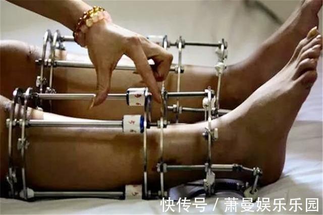 身高|男子花费58万“拉骨”,只为增高5厘米,网友们大呼无法理解