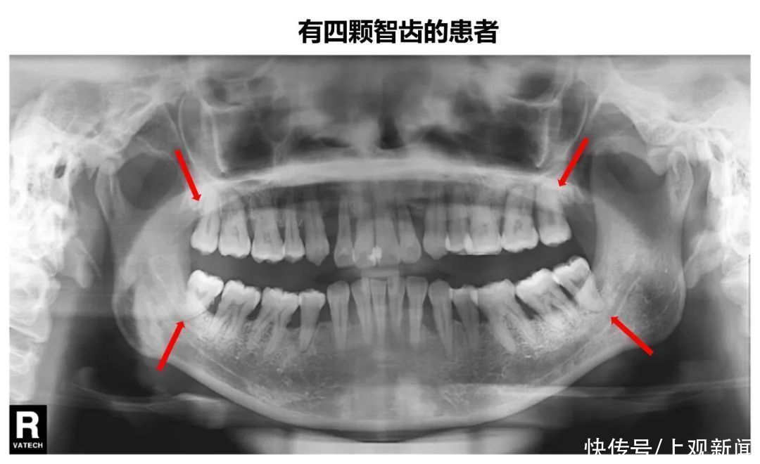 事项|5岁女童拔牙,大出血脑死亡!拔牙前,这些事项一定要知道