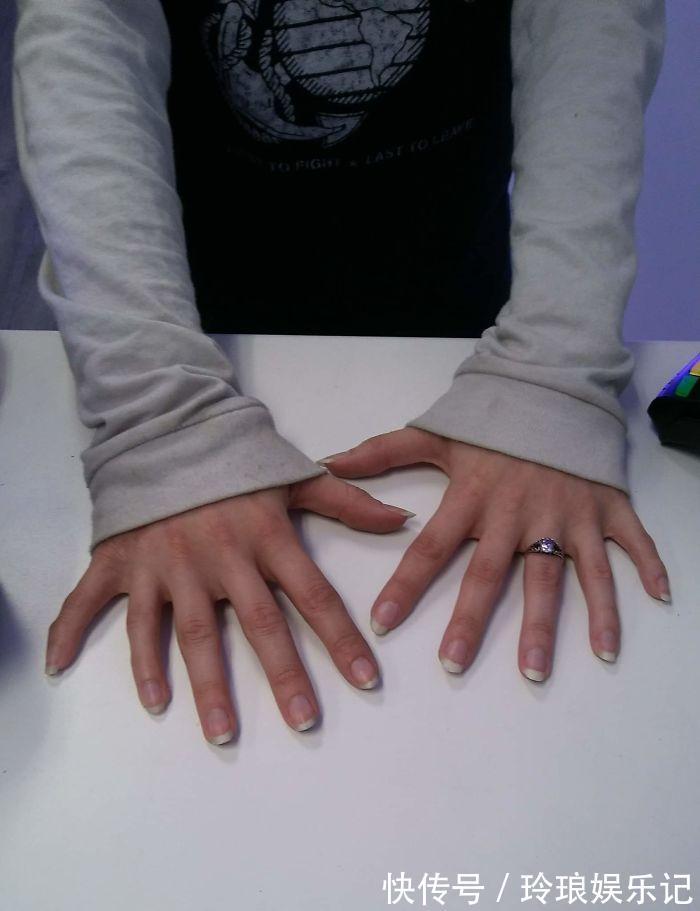 脚趾|19个“被上帝挑选过”的特殊基因人类,怎么梳都不整齐的头发