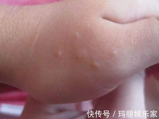 水泡|夏天出汗后,手脚出现水泡是怎么回事不重视可能危害健康