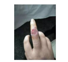 虾刺|19岁姑娘被虾刺了一下，手指红肿溃烂，20多天没愈合