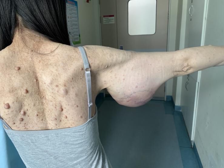 肿瘤|罕见！胳膊上长出排球大的肿瘤 医生成功完整切除