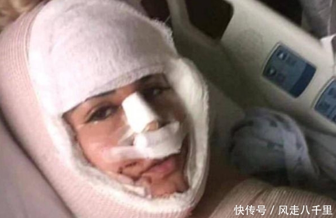整容|女子花重金整容，一年经历13次整容手术，整容前后判若两人