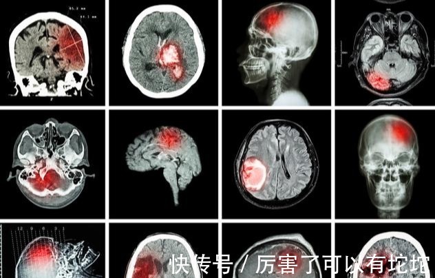 一家人|一家三口，不碰烟酒，相继查出脑梗，医生：这2种美食是“祸根”