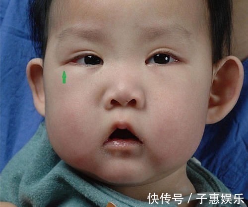 发育不良|宝宝长得太漂亮也是一种病?“歌舞伎综合征”到底是个什么鬼