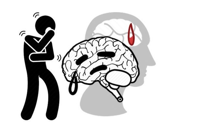 高血压|脑梗一般在哪个年龄段发作?出现3个特征,要重视
