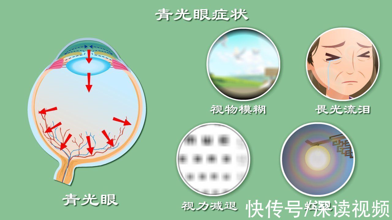 青光眼|视物模糊？畏光流泪？细数第二大致盲眼病——青光眼致盲前啥征兆