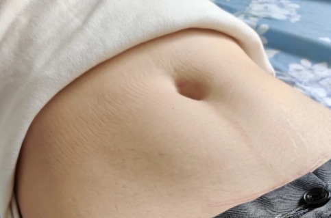 精华乳|生个孩子“肚皮开花”,孕期做好掌握这3点,妊娠纹离你远远的