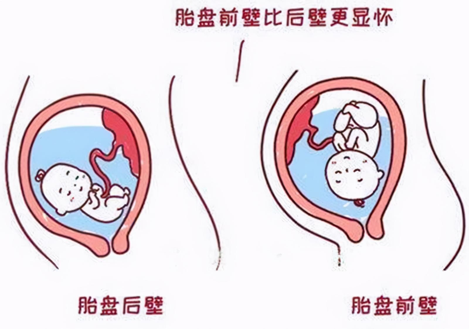 前壁|怀孕两个月,肚子像其他人怀孕四个月一样,是什么原因?