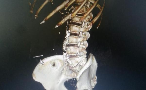 意外|阿婆自行针灸出意外，5厘米断针留在腹中