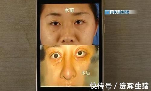 眼角膜|女子花60000整容,术后却整成“凹陷鼻”,找其理论主刀医生闭门不见