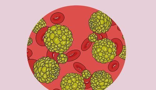 手术治疗|癌症患者做完手术，已经把肿瘤切干净了，为何之后却还是复发了