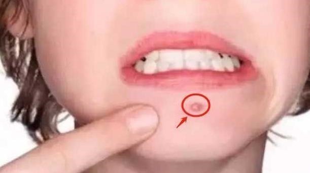 炎症|女性患有妇科炎病脸上多有3大变化，常喝1杯水，抑菌消炎养子宫