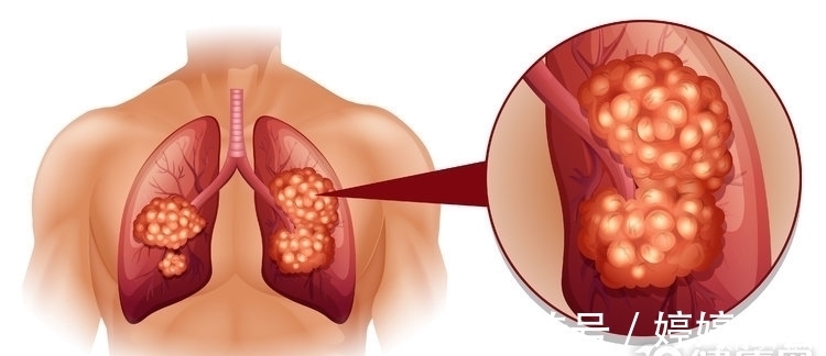 症状|肺癌晚期不治疗,能活多长时间?有3个决定因素