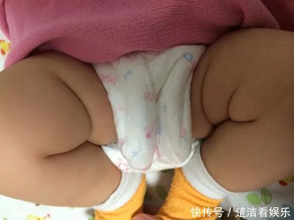 宝宝的臀纹腿纹不对称?一岁前要当心些,排除原因才安心