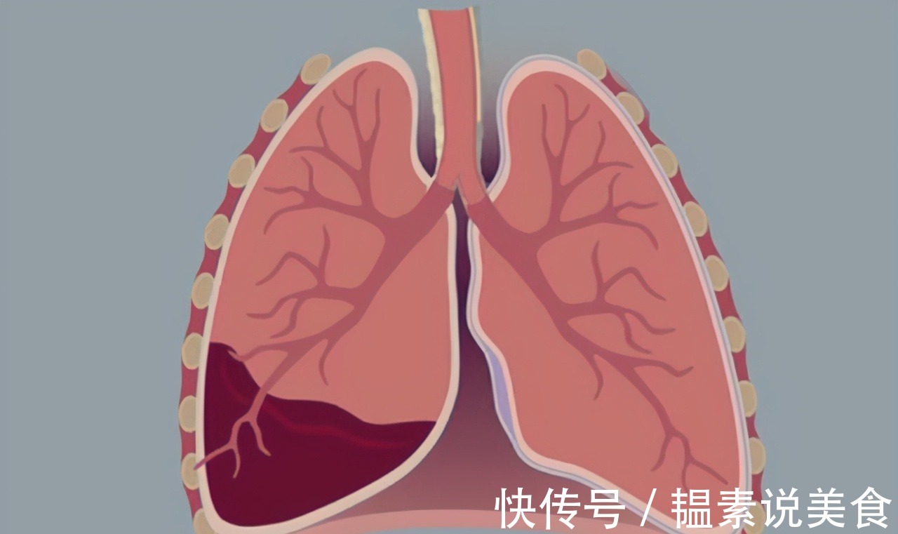 胸水|看中醫效果顯著而忽視病情，發現腫瘤已是晚期，治療后復發咋辦
