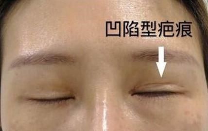 眼睛|双眼皮修复手术可以让眼睛变回初眼的样子吗?