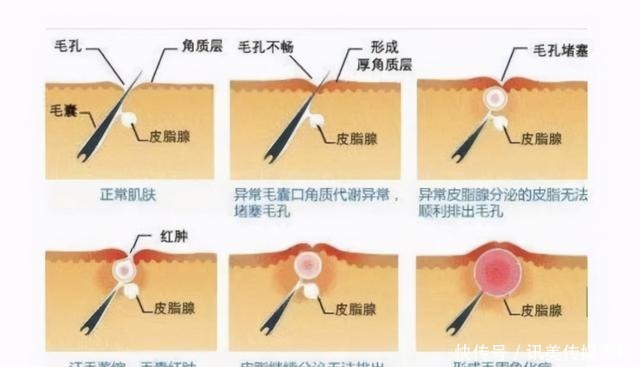 买了裙子，但是鸡皮还没解决！有啥办法缓解鸡皮肤？