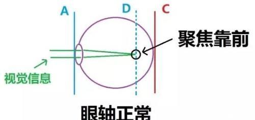 激光类|近视给生活带来不便,这些方法帮您烦恼……