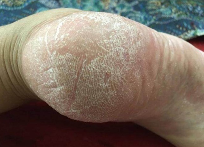 裂田|脚后跟的“裂田”,是因为缺水吗并非那么简单,劝你心里有个数