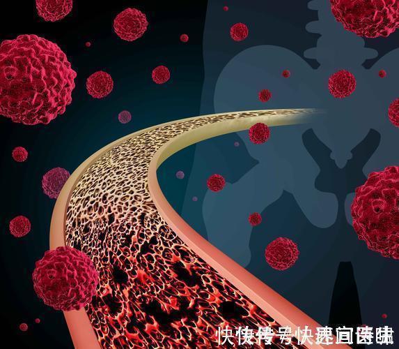 中老年人|癌症是什么病,为什么扩散的速度那么快?若想预防,3点很重要