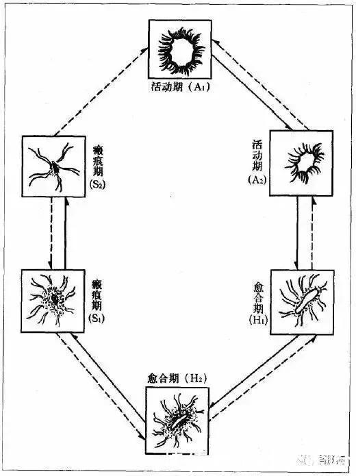 原来胃溃疡是这么分期的,哪种最严重你知道吗