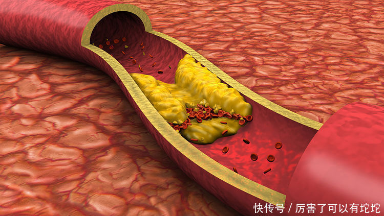 降血脂|每天吃苹果可以降血脂？清华教授：真正降血脂的是3件事