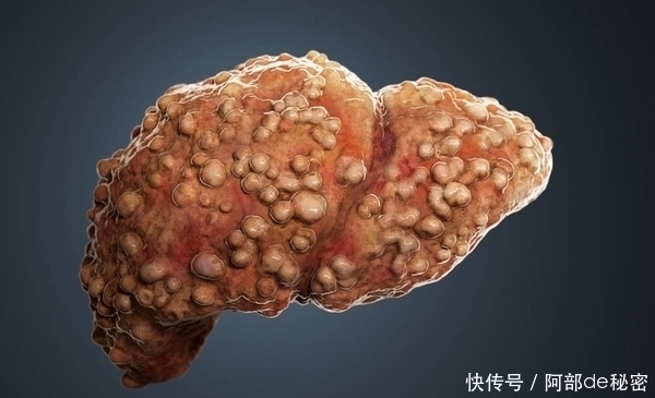 病变|肝硬化害怕“1种水”，不是枸杞水，平时敞开喝，肝脏干净柔软