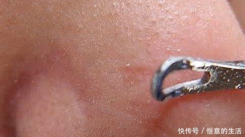 氨基酸洗面奶|先别慌着挤黑头,这3种原因你知道了再挤也不迟!