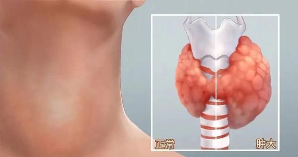 亚甲炎|浅谈甲状腺弥漫性病变