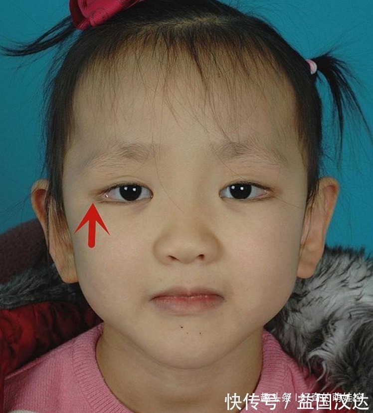 你好漂亮|有一种病叫“孩子太漂亮”,天生自带眼妆,是产检查不出的罕见病
