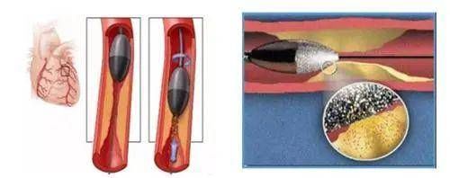 金刚钻|济南市第四人民医院“金刚钻”解决冠脉严重钙化狭窄病变