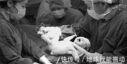 剖腹产|西方发明的一种手术,早期死亡率高达85%,却给中国妇女带来福音!