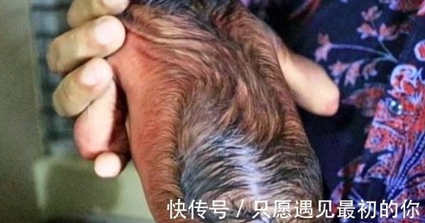 先天性|国外奇葩婴儿“返老还童”,一出生如同80岁老头,父母不惊反喜!