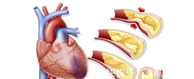 支气管扩张|长期胸闷,检查发现室性早搏,需要治疗吗?医生:还需排除冠心病