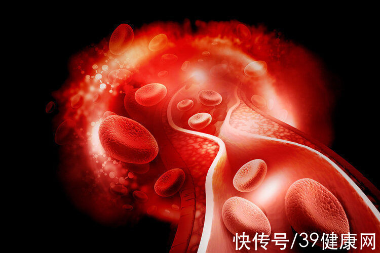 心血管疾病|84岁大爷斑块消失，他把血管变“干净”的2个方法，连医生也赞叹