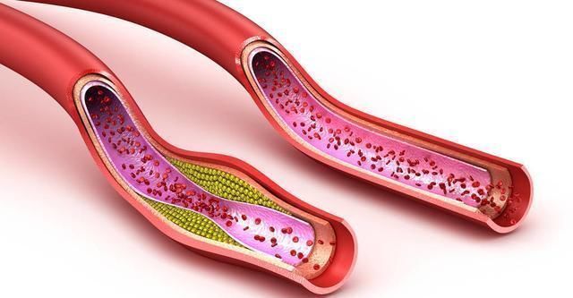 血脂异常|吃木耳能通血管北大教授大错特错,真正能通血管的是这1件事