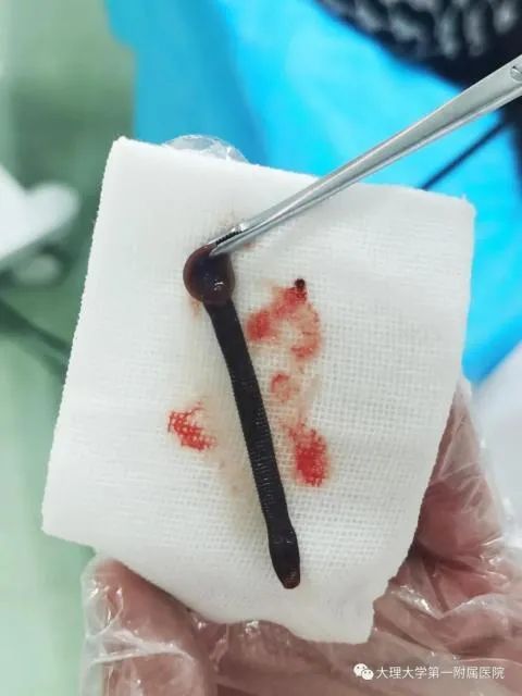 医生|16岁女孩总流鼻血,医生竟从她鼻腔里取出一条活的…...