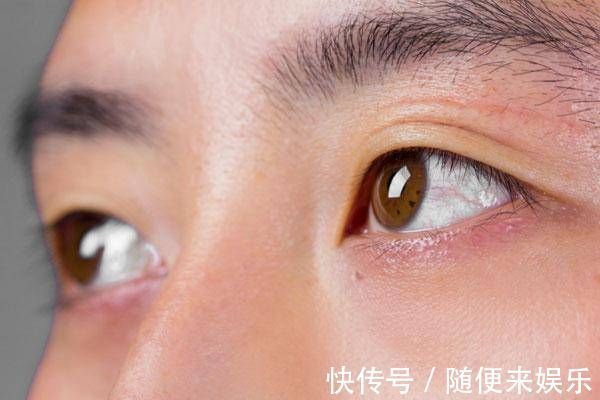 眼球很多红血丝是什么原因