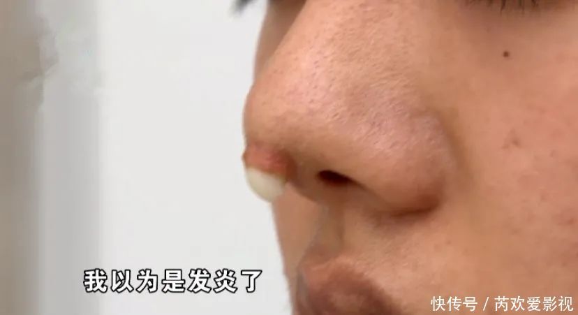 漂亮姑娘刚怀孕,鼻尖出现神秘白色物体!婆婆追问下,她瞒不住了…