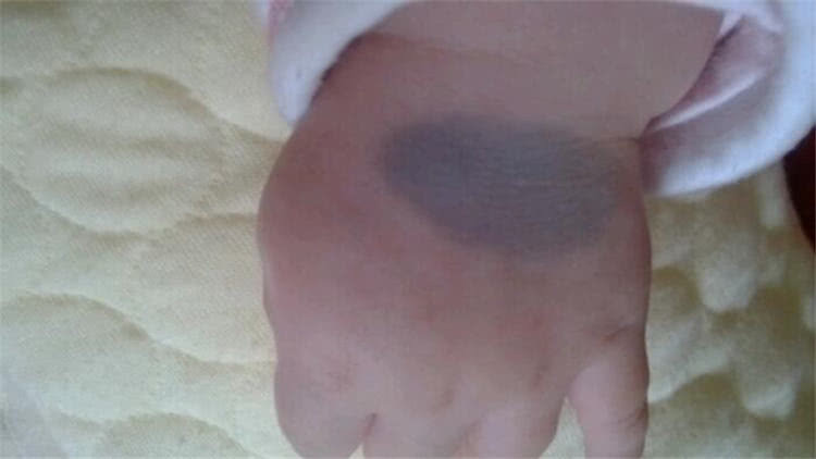 新生儿|胎记是怎么来的,有人说是被阎王爷打答案可能不是你所想的